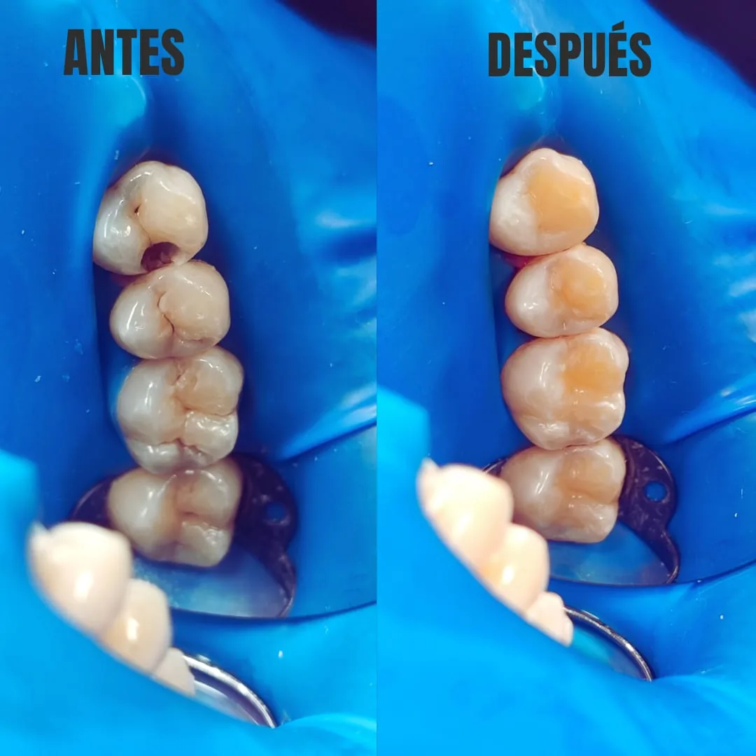 Caso clínico dental antes y después de restauración