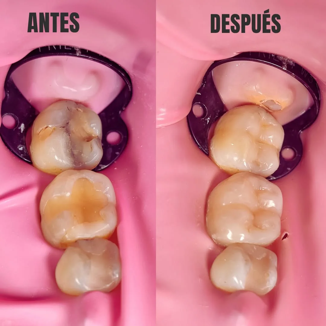 Caso clínico dental antes y después de tratamiento restaurador