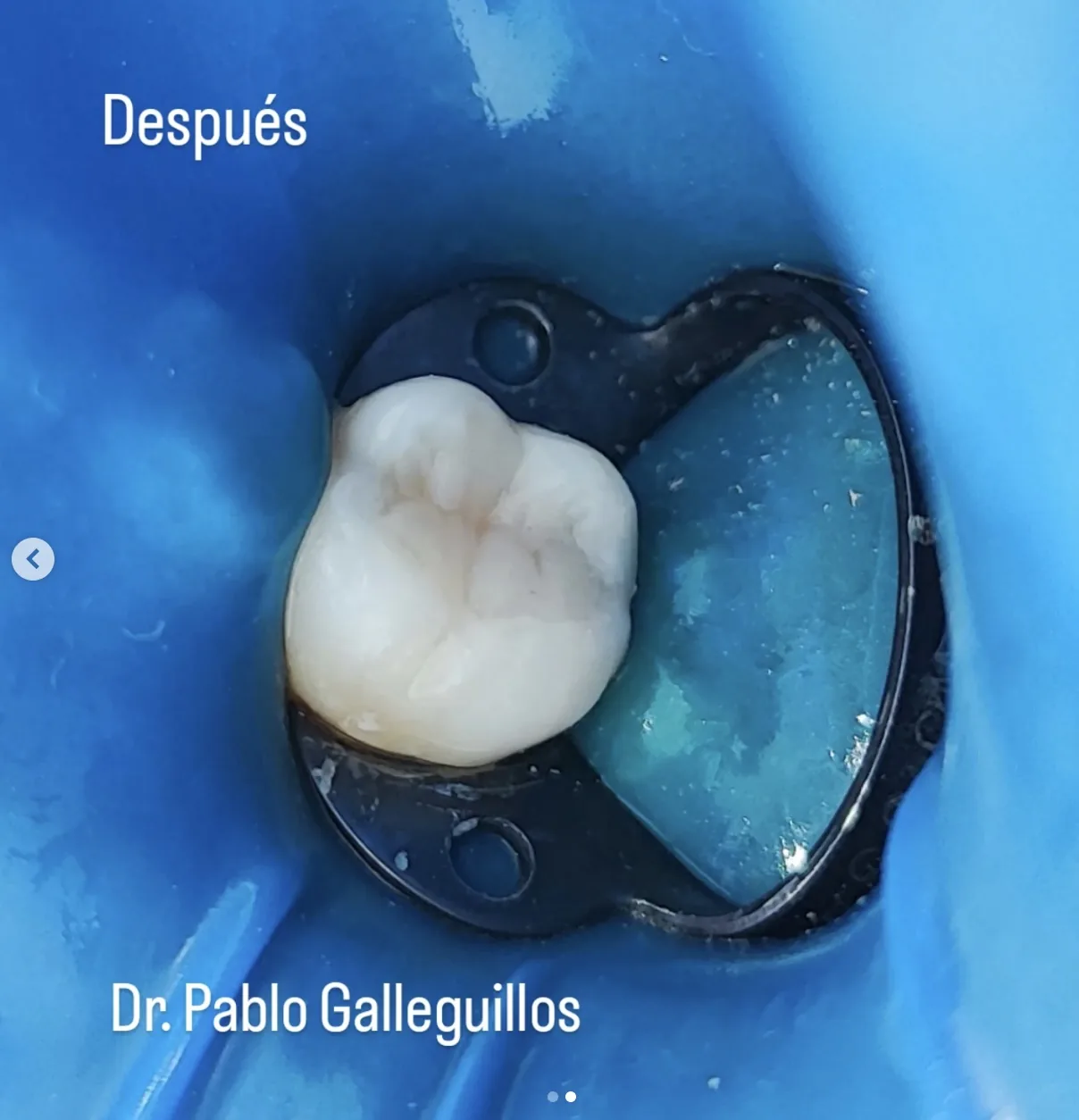 Resultado de caso clínico dental restaurado